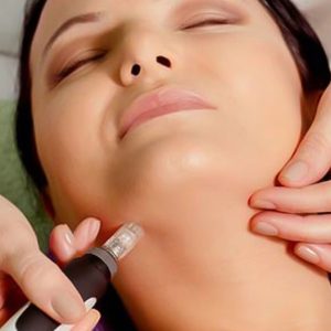 1 Ou 2 Séances De Soin Microneedling Avec Lv Beauté Fréjus – Saint-Raphaël OohN.com Special Offers, Deals & Discounts in France