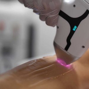 5 Séances Dépilation Au Laser Des Aisselles Avec Dépiléo Herrlisheim Strasbourg OohN.com Special Offers, Deals & Discounts in France