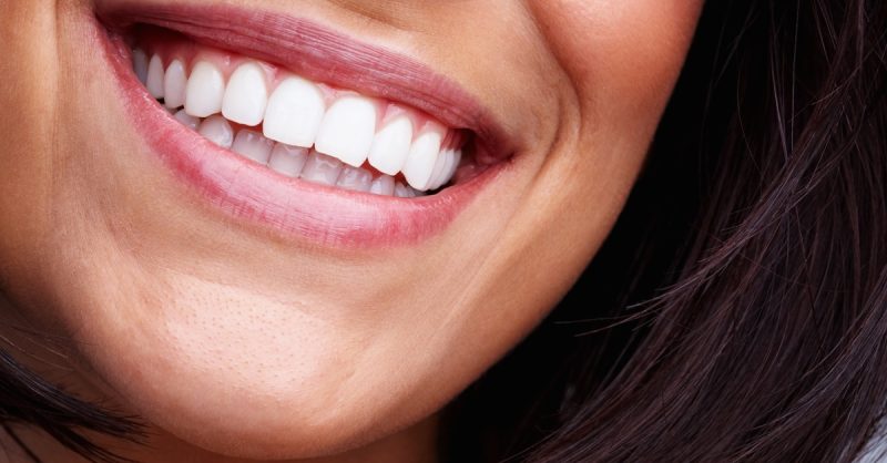 Jusquà 72% De Remise Sur Blanchiment Des Dents – Traditionnel Chez L’Institut Par Point Soleil Paris OohN.com Special Offers, Deals & Discounts in France