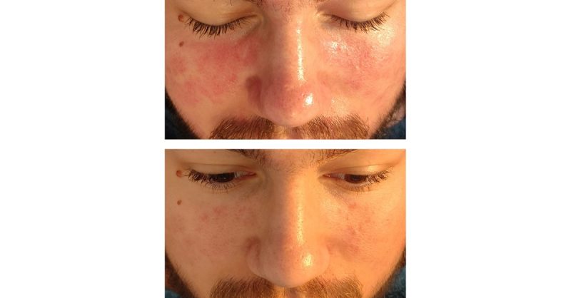 Offrez-Vous Une Pause Beauté Avec Un Soin Hydrafacial© Ou Hydraluxe Montpellier OohN.com Special Offers, Deals & Discounts in France 3