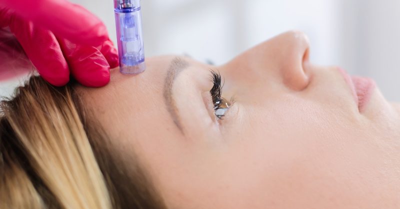 Séance De Microneedling Avec Coachperfectionstudio Nice OohN.com Special Offers, Deals & Discounts in France