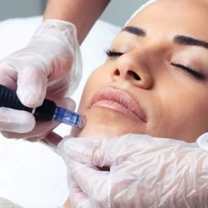 Séance De Microneedling De 60 Min Avec Ô Soins Daure (44% De Remise) Antibes – Cannes OohN.com Special Offers, Deals & Discounts in France