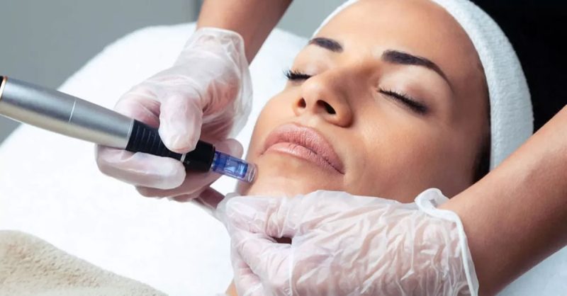 Séance De Microneedling De 60 Min Avec Ô Soins Daure (44% De Remise) Antibes – Cannes OohN.com Special Offers, Deals & Discounts in France