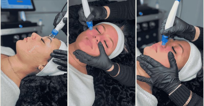Séance Dhydrafacial Et/Ou De Dermapen Chez Luxeclat Metz OohN.com Special Offers, Deals & Discounts in France 2